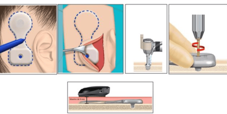 Implantes Osteointegrados: La alternativa ideal para audífonos convencionales